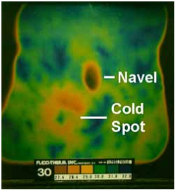 cold spot in epilepsy